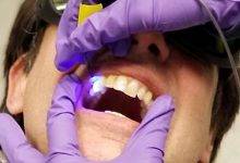 حسگر برای شناسایی دندان‌های در معرض خطر پوسیدگی
