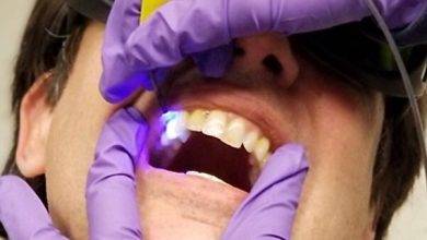 حسگر برای شناسایی دندان‌های در معرض خطر پوسیدگی